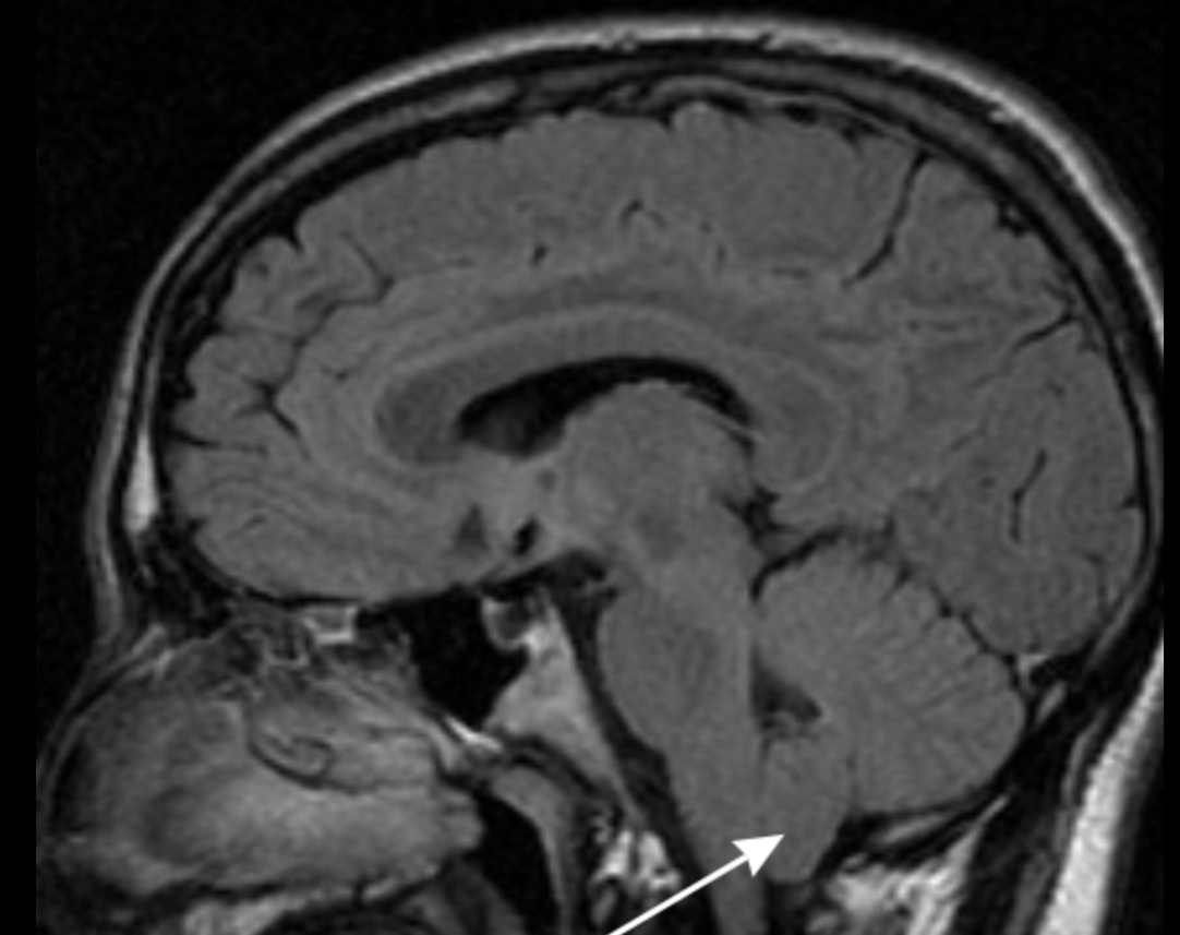 Imagen ilustrativa de malformación de Arnold–Chiari