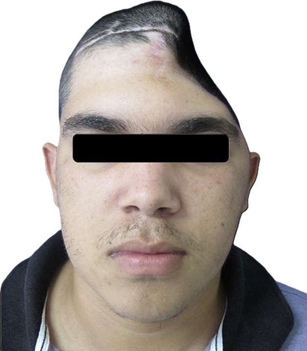 Imagen ilustrativa de un defecto óseo