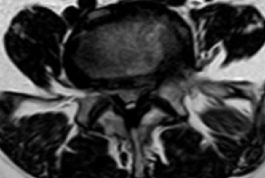 Imagen ilustrativa de raquiestenosis lumbar